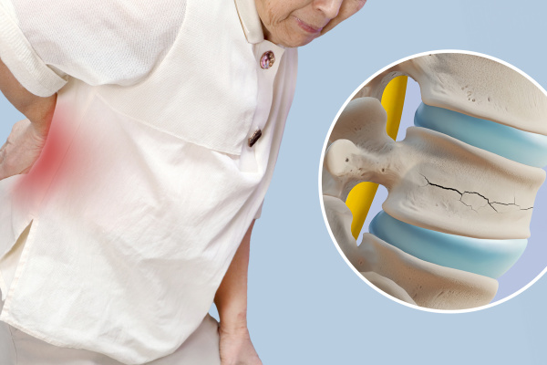 Osteoporoza