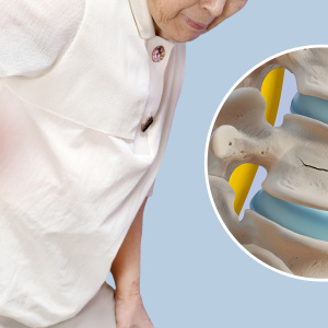 Osteoporoza