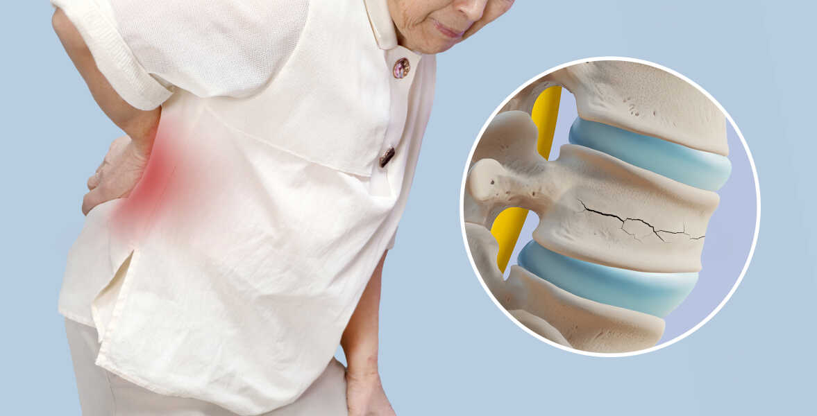 Osteoporoza